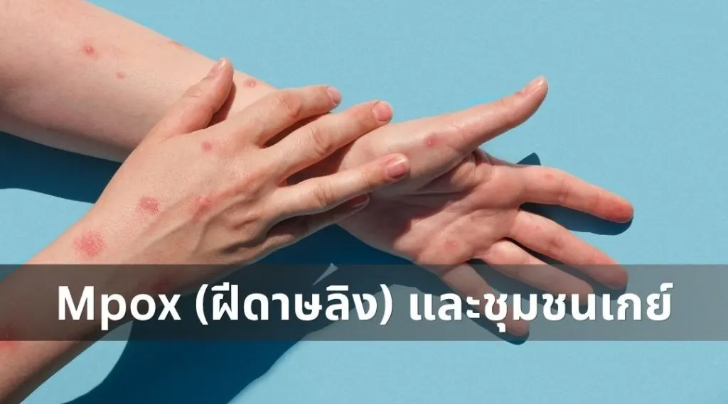 Mpox (ฝีดาษลิง) และชุมชนเกย์